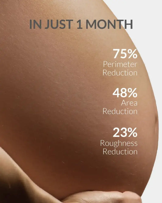 Stretch Marks Cream