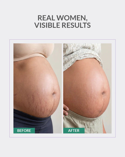 Stretch Marks Fade & Repair Duo