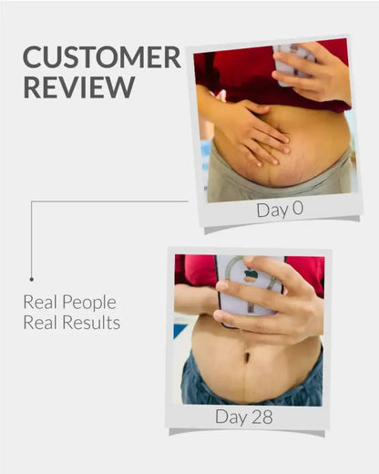 Stretch Marks Cream